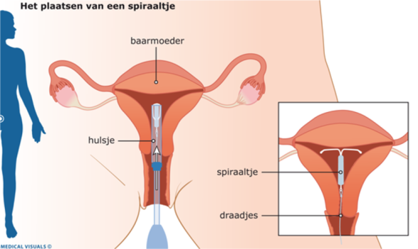 Hoe Lang Pijn Na Plaatsen Spiraal